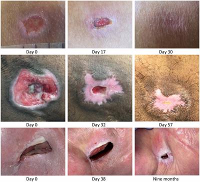 Stable closure of acute and chronic wounds and pressure ulcers and control of draining fistulas from osteomyelitis in persons with spinal cord injuries: non-interventional study of MPPT passive immunotherapy delivered via telemedicine in community care